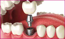 Vista de una boca con un implante