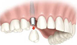 boca con un implante dental
