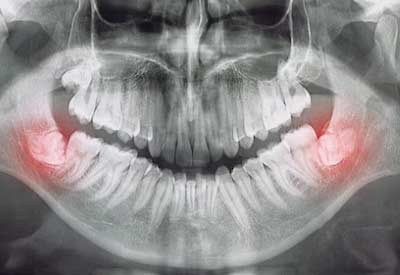 Radiografia de una boca con muelas del juicio