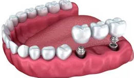 protesis dental