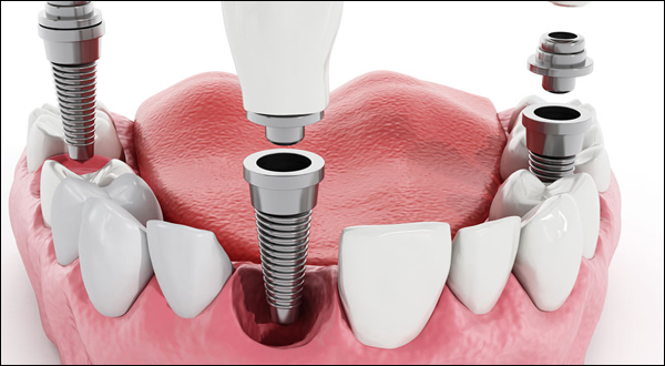 Imagen de parte de una boca con 3 implantes